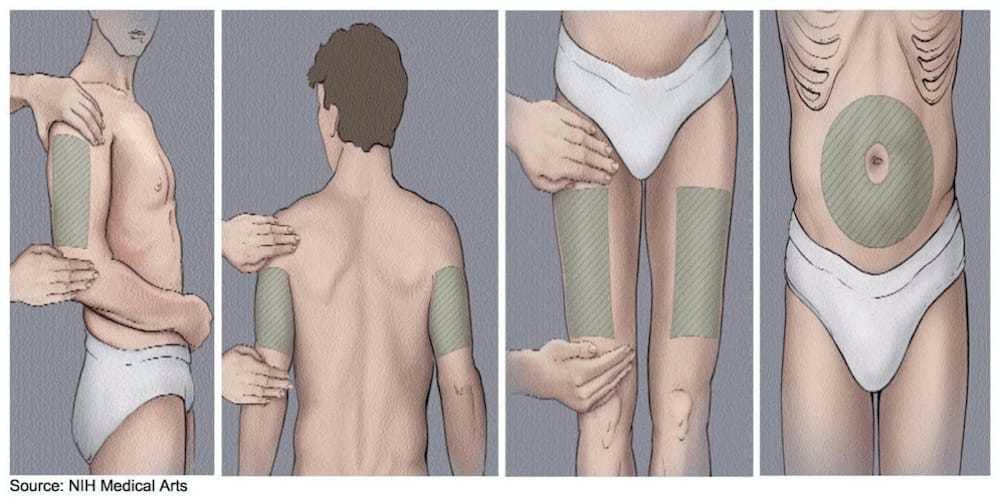 Subcutaneous B12 Injection Sites.