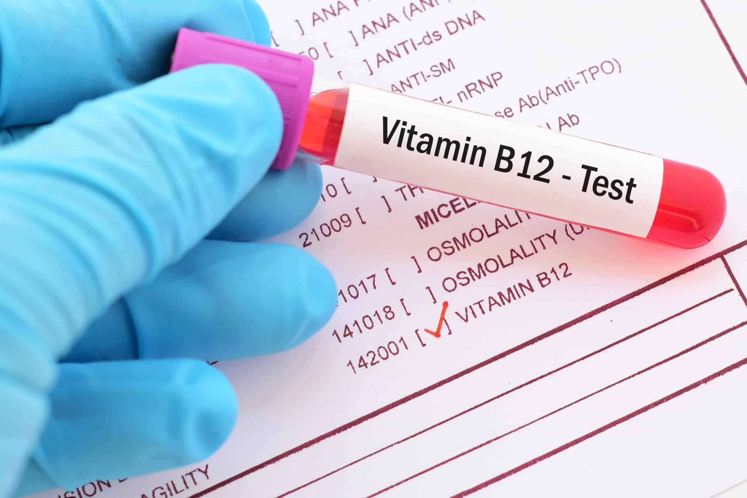 Vitamin B12 blood level test vial.