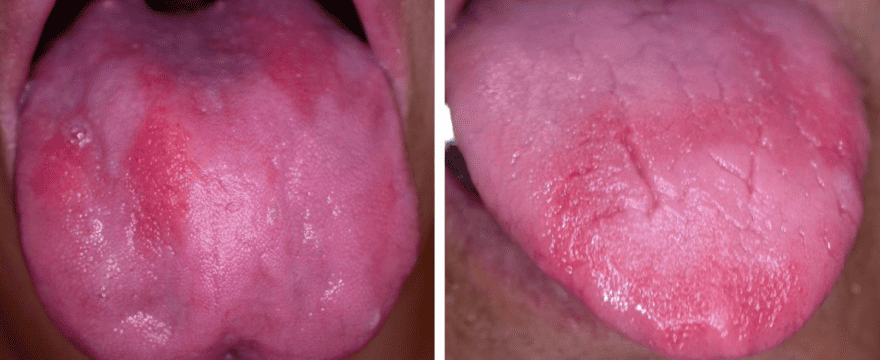 The red, beefy, "B12 deficiency tongue"