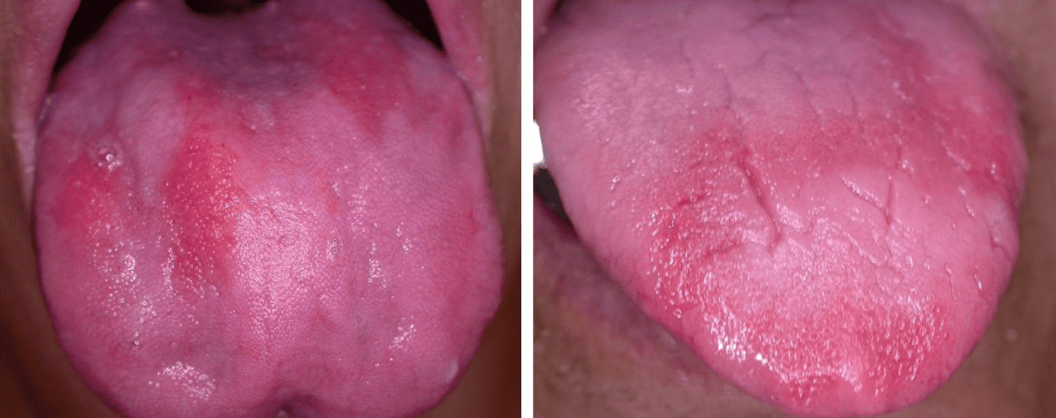 B12 deficiency tongue or pernicious anemia tongue images